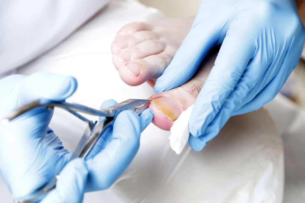 How to get rid of ingrown toenail?