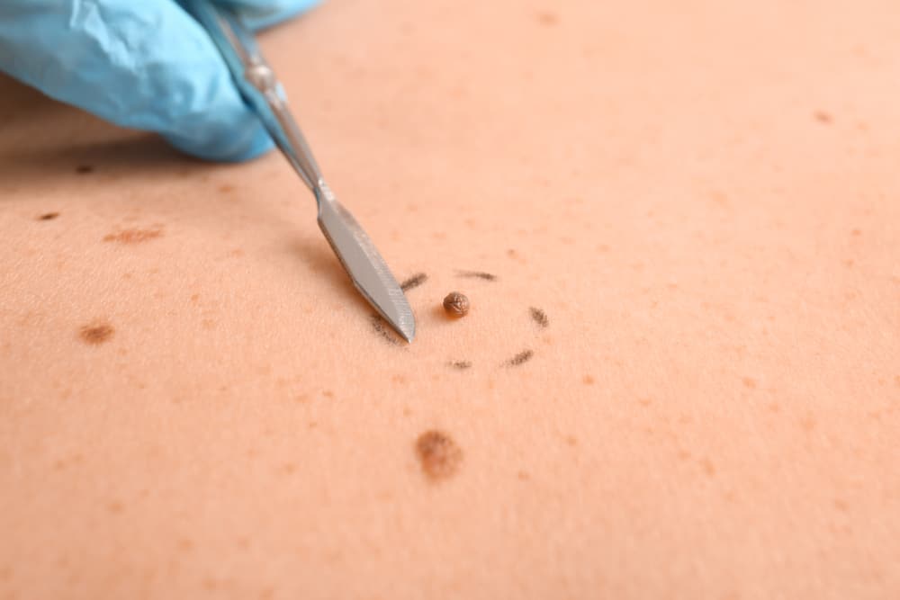 methods to remove moles permanently