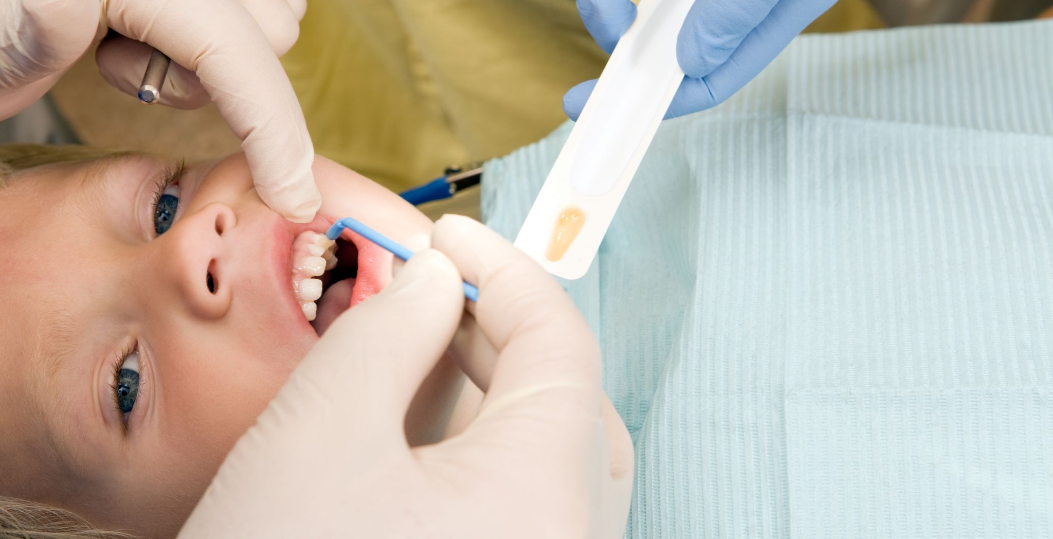 fluoride treatment benefits, is fluoride treatment worth it, fluoride dental treatment, fluoride for cavity prevention, fluoride treatment effectiveness, dental fluoride application, fluoride treatment pros and cons