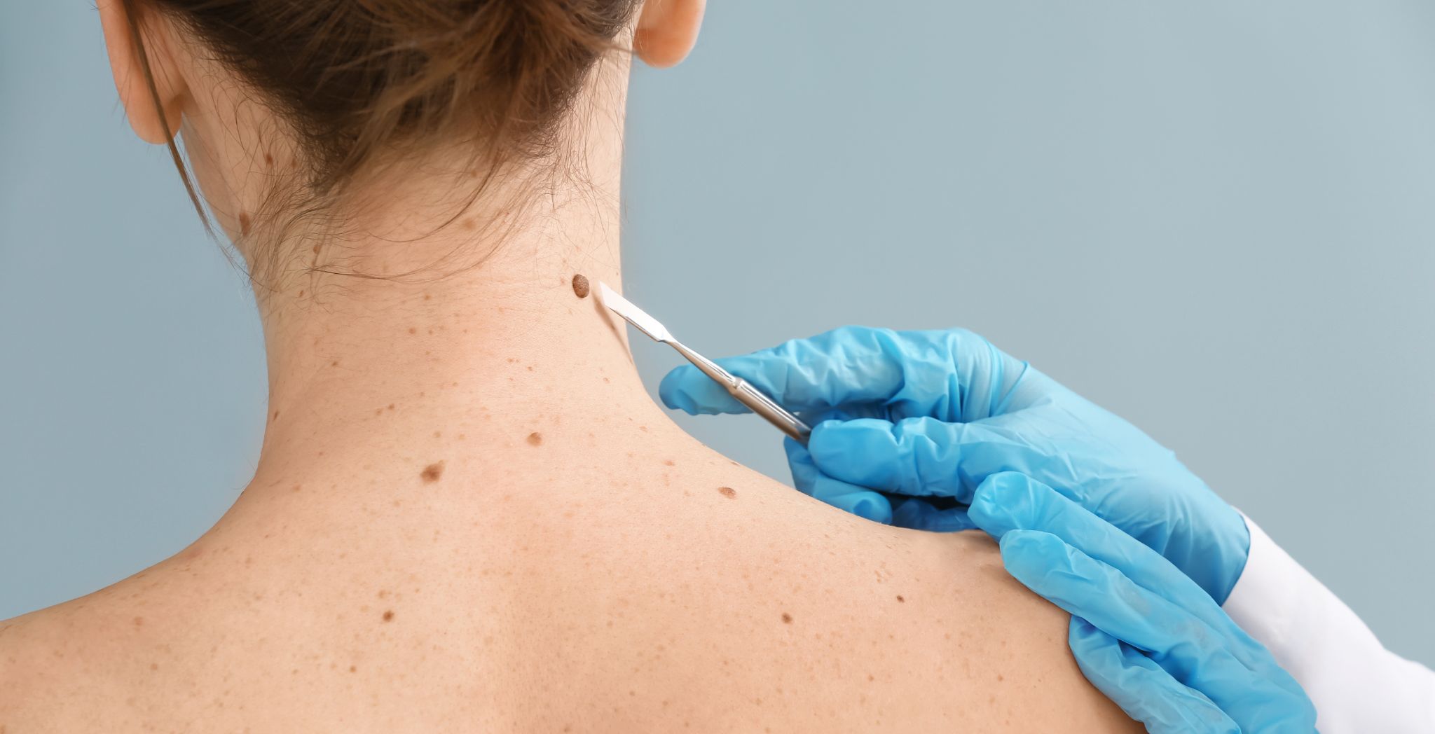 Skin Cancer Check, Skin cancer screening, Skin cancer examination, Mole check for skin cancer, Dermatologist skin cancer check, Early detection of skin cancer, Full body skin exam, Skin lesion evaluation, Skin cancer prevention check