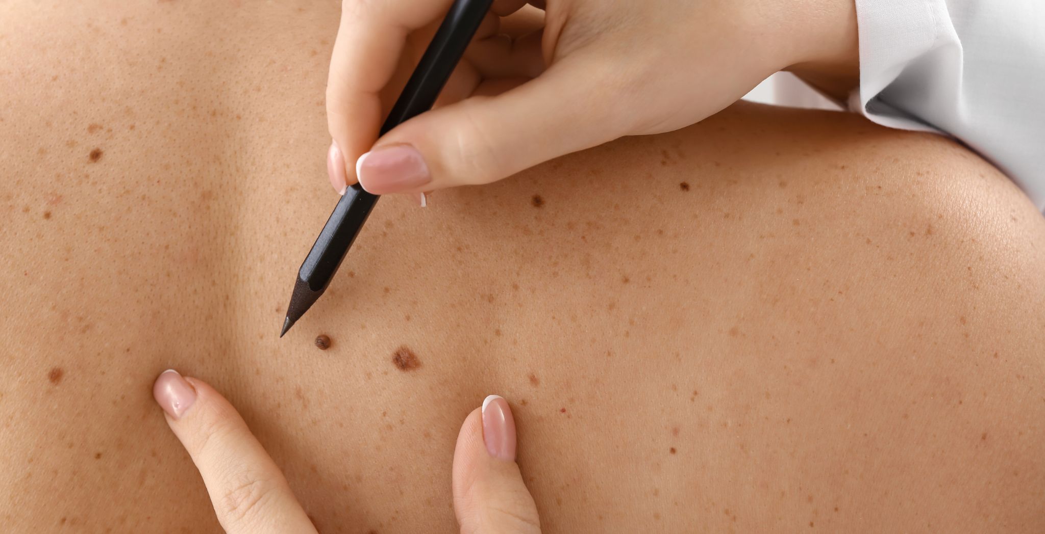 Removing skin cancer, Skin cancer excision, Skin cancer surgery, Mohs surgery procedure, Skin lesion removal, Basal cell carcinoma removal, Melanoma excision